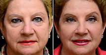 No More Puffy Eyes: Do This Before Breakfast (Click Here)