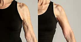 Extra Arm Skin? This Is The #1 Over-The-Counter Skin Tightener