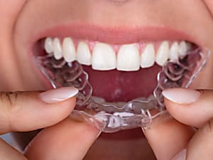 Los dentistas esconden esta fácil y asequible solución para los dientes tor