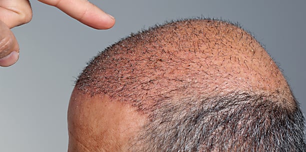 El precio de un trasplante de pelo en Maldonado podría sorprenderte